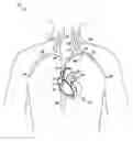 Fig. 01 - Coronary sinus lead delivery catheter