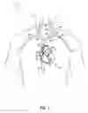 Fig. 02 - Coronary sinus lead delivery catheter