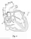 Fig. 07 - Coronary sinus lead delivery catheter