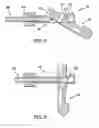 Fig. 05 - Percutaneous interspinous distraction device and method