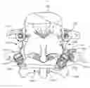 Fig. 01 - Linked bilateral spinal facet implants and methods of use