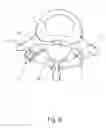 Fig. 07 - Linked bilateral spinal facet implants and methods of use