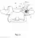 Fig. 22 - Linked bilateral spinal facet implants and methods of use