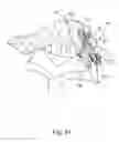 Fig. 33 - Linked bilateral spinal facet implants and methods of use