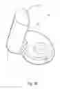 Fig. 40 - Linked bilateral spinal facet implants and methods of use