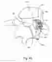 Fig. 47 - Linked bilateral spinal facet implants and methods of use