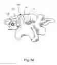 Fig. 52 - Linked bilateral spinal facet implants and methods of use