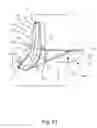Fig. 53 - Linked bilateral spinal facet implants and methods of use