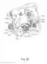 Fig. 65 - Linked bilateral spinal facet implants and methods of use