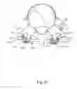 Fig. 67 - Linked bilateral spinal facet implants and methods of use