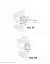Fig. 07 - Method and apparatus for the treatment of the intervertebral disc annulus