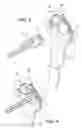 Fig. 09 - Method for performing trans-anal resection with a curved cutter stapler