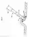 Fig. 14 - Wound closure devices and methods
