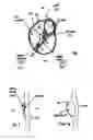 Fig. 02 - PATENT FORAMEN OVALE CLOSURE METHOD