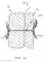 Fig. 06 - PATENT FORAMEN OVALE CLOSURE METHOD