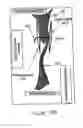 Fig. 11 - PATENT FORAMEN OVALE CLOSURE METHOD