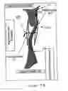 Fig. 12 - PATENT FORAMEN OVALE CLOSURE METHOD
