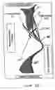 Fig. 13 - PATENT FORAMEN OVALE CLOSURE METHOD
