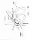 Fig. 17 - PATENT FORAMEN OVALE CLOSURE METHOD