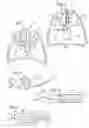 Fig. 02 - Apparatus and method for deployment of a bronchial obstruction device