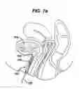Fig. 08 - Conductive mesh for neurostimulation