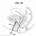 Fig. 09 - Conductive mesh for neurostimulation