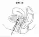 Fig. 10 - Conductive mesh for neurostimulation