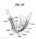 Fig. 19 - Conductive mesh for neurostimulation