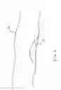 Fig. 02 - Medical device for unstable and vulnerable plaque
