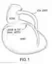 Fig. 02 - INTRAVASCULAR MEDICAL DEVICE