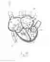 Fig. 11 - Apparatus and method for treating a regurgitant valve