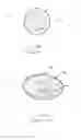 Fig. 14 - Apparatus and method for treating a regurgitant valve