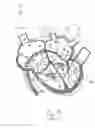 Fig. 15 - Apparatus and method for treating a regurgitant valve