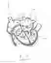 Fig. 16 - Apparatus and method for treating a regurgitant valve