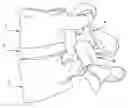 Fig. 01 - Facet joint replacement