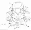 Fig. 03 - Facet joint replacement