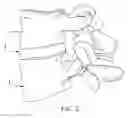 Fig. 04 - Facet joint replacement