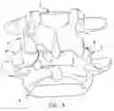 Fig. 05 - Facet joint replacement