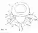 Fig. 08 - Facet joint replacement