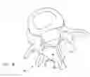 Fig. 10 - Facet joint replacement