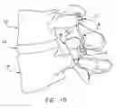 Fig. 12 - Facet joint replacement