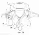 Fig. 14 - Facet joint replacement