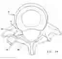 Fig. 16 - Facet joint replacement