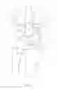 Fig. 02 - Methods and devices for resurfacing the wrist joint