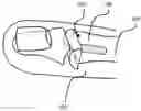 Fig. 01 - SMALL JOINT HEMIARTHROPLASTY