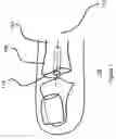 Fig. 02 - SMALL JOINT HEMIARTHROPLASTY