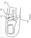 Fig. 03 - SMALL JOINT HEMIARTHROPLASTY