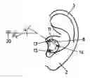 Fig. 01 - Method for manufacturing a hearing device and a use of the method