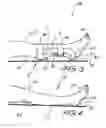 Fig. 03 - Pressure ulcer prosthesis and method for treating and/or preventing pressure ulcers