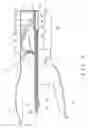 Fig. 04 - Pliers type stapler